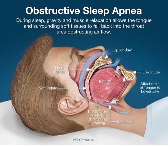 Obstructive Sleep Apnea Graphic