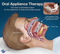 Oral Appliance Therapy Graphic