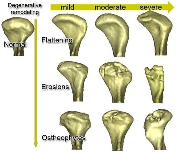 Degenerative remodeling