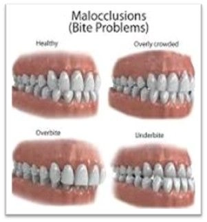 Malocclusions (Bite Problems)