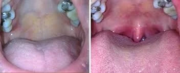 Laser Therapy Before and AFter